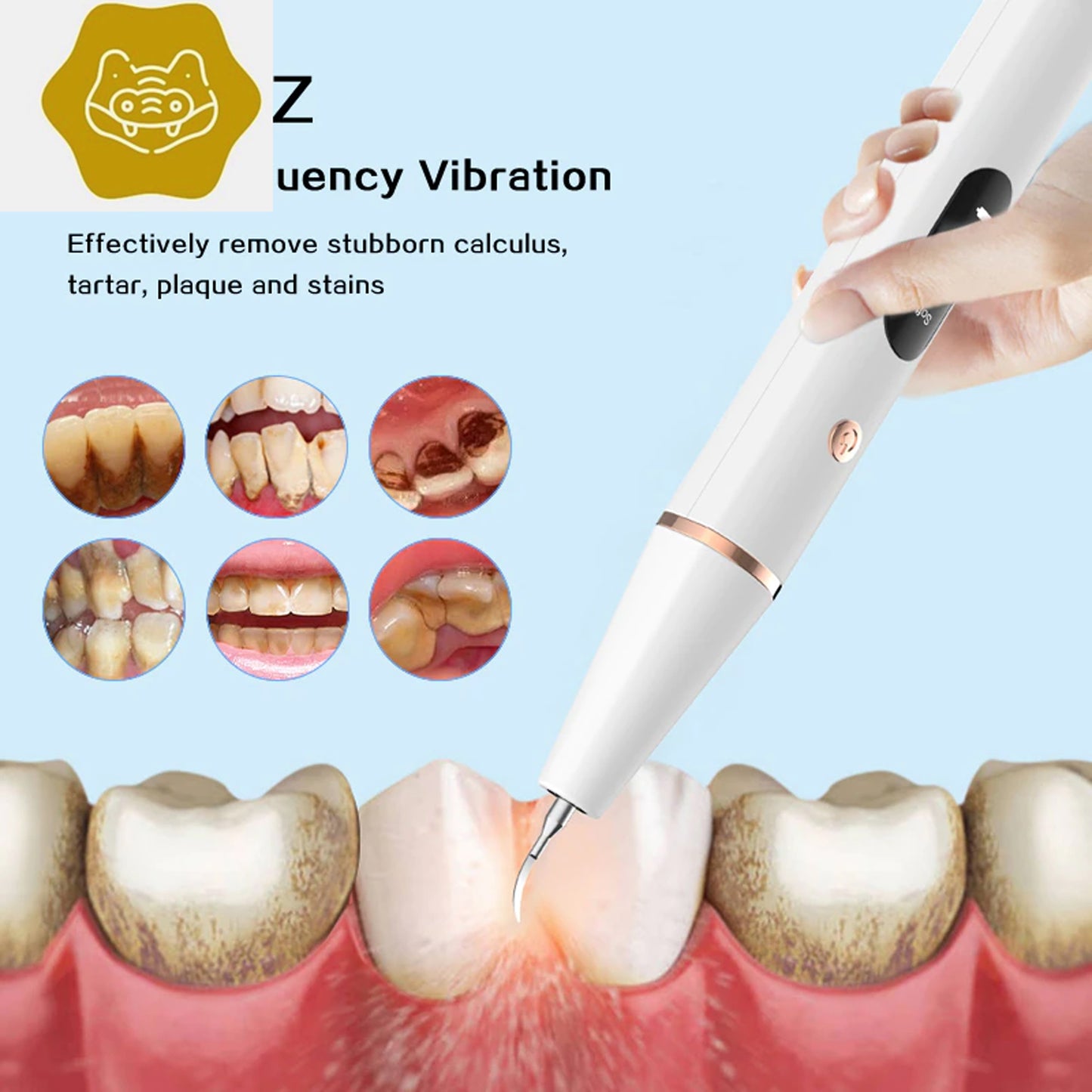 Plaque Remover for Teeth - A