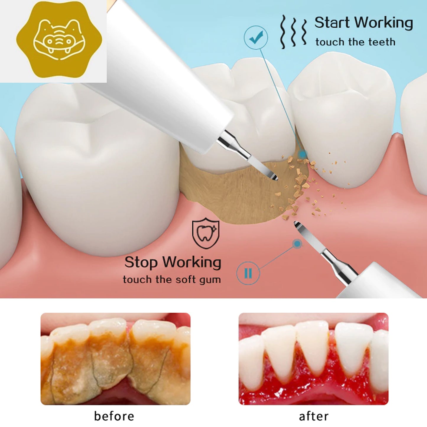 Plaque Remover for Teeth - A